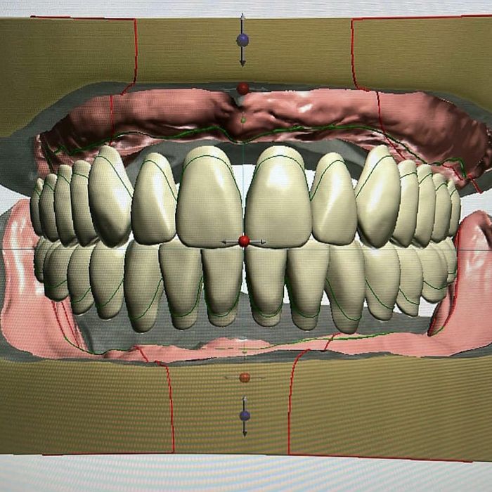 digital-dentures
