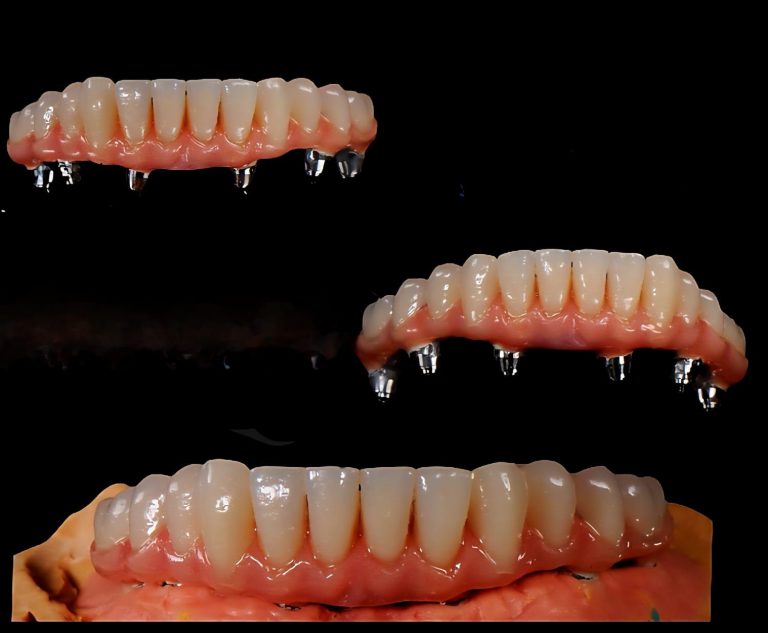 implant-dentures